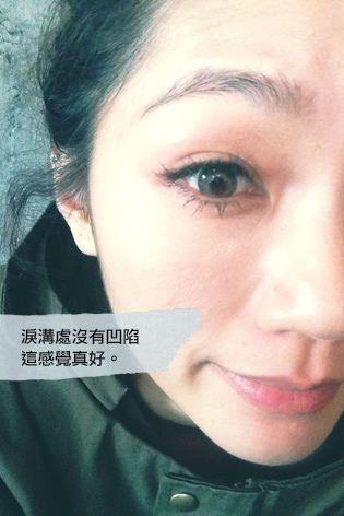 淚溝 眼袋 醫學美容 楊氏羅丹